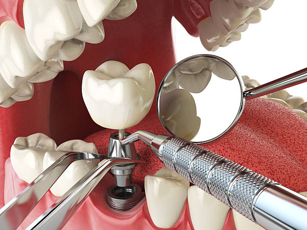 Best Dental Abscess Treatment in Rmel By The Sea, CA